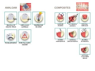 AMALGAM COMPOSITES
 
