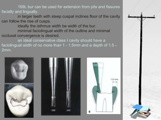 169L bur can be used for extension from pits and fissures
facially and lingually.
in larger teeth with steep cuspal inclines floor of the cavity
can follow the rise of cusps.
ideally the isthmus width be width of the bur.
minimal faciolingual width of the outline and minimal
occlusal convergence is desired.
an ideal conservative class I cavity should have a
faciolingual width of no more than 1 - 1.5mm and a depth of 1.5 -
2mm.
 