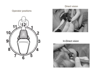 Operator positions
Direct vision
In-Direct vision
 