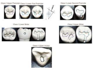 Class I Upper Premolar Class I Lower First Premolar Class I Lower Second Premolar
Class I Lower Molar Class I Upper Molar
Class I Upper Incisor
 