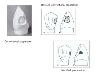 Conventional preparation
Beveled Conventional preparation
Modified preparation
 