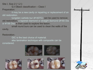 Site I, Size 2 [ 1.2 ]:
G.V.Black classification – Class I
Preparation:
it may be a new cavity or repairing or replacement of an
old restoration.
tungsten carbide bur (#140TC) can be used to remove
old restoration, a tapered diamond or straight diamond (#160 Dia
or #156 Dia) is then used to explore the lesion.
small round burs can be used to clean the walls of the
cavity.
Restoration:
GIC is the best choice of material.
also lamination technique with composite can be
considered.
 