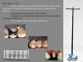 Site I Size 4 [1.4] :
this is an extensive cavitated lesion there will be one or
more loss of cusps full restoration with direct restoration is
difficult.
preparation is same as for size 3 lesion.
amalgam as a restorative material could be used with
mechanical interlocks.
a full crown is the most ideal restoration.
 
