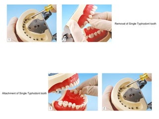 Removal of Single Typhodont tooth
Attachment of Single Typhodont tooth
 