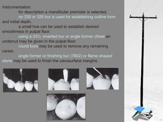 Instrumentation:
for description a mandibular premolar is selected.
no 330 or 329 bur is used for establishing outline form
and initial depth.
a small hoe can be used to establish desired
smoothness in pulpal floor.
using a 33½ inverted bur or angle former chisel an
undercut may be given in the pulpal floor.
round burs may be used to remove any remaining
caries.
angle former or finishing bur (7802) or flame shaped
stone may be used to finish the cavosurface margins.
 