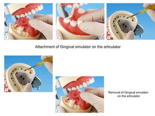 Attachment of Gingival simulator on the articulator
Removal of Gingival simulator
on the articulator
 