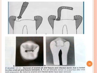 Class i cavity preparation | PPTX