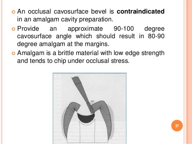 Class I Cavity Preparation