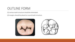 OUTLINE FORM
(1) carious tooth structure should be eliminated.
(2) margins should be placed on sound tooth structure.
 