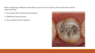 When replacing a defective restoration (recurrent caries lesion), the outline form will be
determined by
1. The outline form of the old restoration.
2. Additional carious lesion.
3. The resistance form required
 