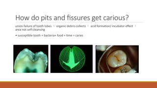 How do pits and fissures get carious?
union failure of tooth lobes  organic debris collects  acid formation/ incubator effect 
area not self cleansing
• susceptible tooth + bacteria+ food + time = caries
 