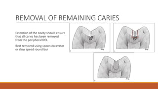 REMOVAL OF REMAINING CARIES
Extension of the cavity should ensure
that all caries has been removed
from the peripheral DEJ.
Best removed using spoon excavator
or slow speed round bur
 