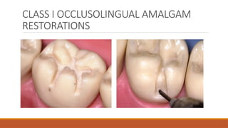 CLASS I OCCLUSOLINGUAL AMALGAM
RESTORATIONS
 