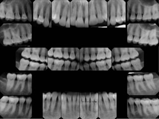 AAP 2017 CLASSIFICATION OF PERIODONTAL DISEASE PART 1 | PPTX