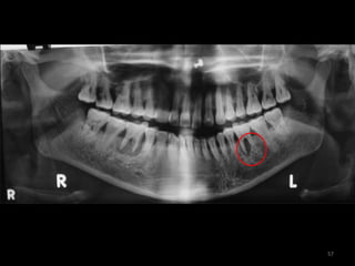 AAP 2017 CLASSIFICATION OF PERIODONTAL DISEASE PART 1 | PPTX