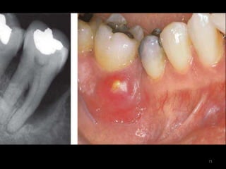 AAP 2017 CLASSIFICATION OF PERIODONTAL DISEASE PART 1 | PPTX