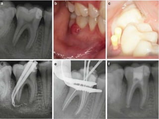 AAP 2017 CLASSIFICATION OF PERIODONTAL DISEASE PART 1 | PPTX