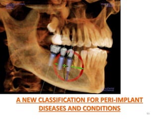 AAP 2017 CLASSIFICATION OF PERIODONTAL DISEASE PART 1 | PPTX
