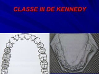 CLASSE III DE KENNEDY 