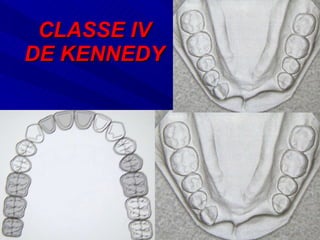 CLASSE IV DE KENNEDY 