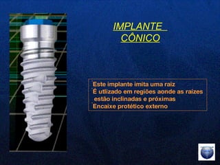 IMPLANTE  CÔNICO Este implante imita uma raiz É utlizado em regiões aonde as raízes  estão inclinadas e próximas  Encaixe protético externo 