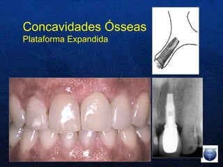 Concavidades Ósseas Plataforma Expandida 