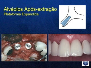 Alvéolos Após-extração Plataforma Expandida 