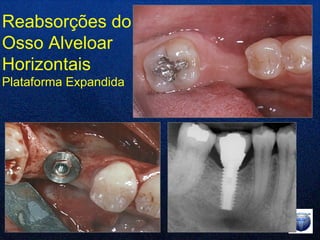 Reabsorções do Osso Alveloar Horizontais Plataforma Expandida 