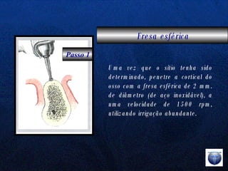 Fresa esférica Uma vez que o sítio tenha sido determinado, penetre a cortical do osso com a fresa esférica de 2 mm. de diâmetro (de aço inoxidável), a uma velocidade de 1500 rpm, utilizando irrigação abundante. Passo 1 