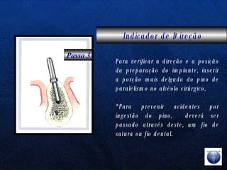 Indicador de Direção Passo 3 Para verificar a direção e a posição da preparação do implante, inserir a porção mais delgada do pino de paralelismo no alvéolo cirúrgico. *Para prevenir acidentes por ingestão do pino,  deverá ser passado através deste, um fio de sutura ou fio dental. 