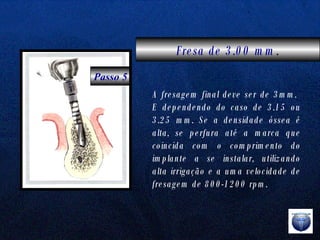 Fresa de 3.00 mm . Passo 5 A fresagem final deve ser de 3mm.  E dependendo do caso de 3.15 ou 3.25 mm. Se a densidade óssea é alta, se perfura até a marca que coincida com o comprimento do implante a se instalar, utilizando alta irrigação e a uma velocidade de fresagem de 800-1200 rpm.  