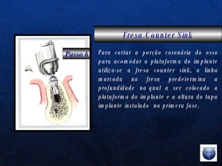 Fresa Counter Sink   Passo 6 Para cortar a porção coronária do osso para acomodar a plataforma do implante utiliza-se a fresa counter sink, a linha marcada na fresa predetermina a profundidade  na qual  a  ser  colocado  a plataforma do implante e a altura do tapa implante instalado  na primera fase. 