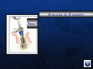Remoção do Montador Passo 9 