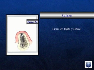 Sutura Paso 11 Cierre de tejido y sutura 