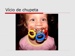 Vício de chupeta
 