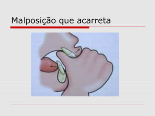 Malposição que acarreta
 