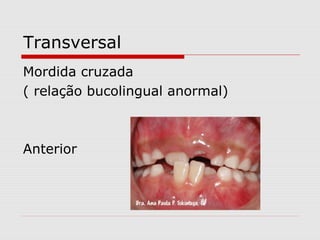 Transversal
Mordida cruzada
( relação bucolingual anormal)
Anterior
 