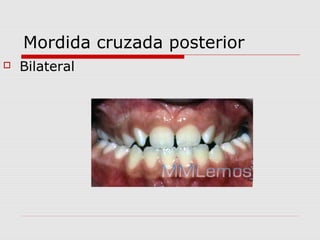 Mordida cruzada posterior
 Bilateral
 