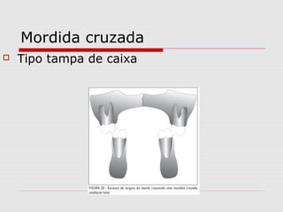 Mordida cruzada
 Tipo tampa de caixa
 
