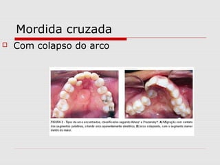 Mordida cruzada
 Com colapso do arco
 