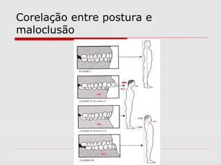 Corelação entre postura e
maloclusão
 