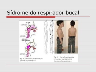Sídrome do respirador bucal
 