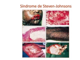 Síndrome de Steven-Johnsons
 