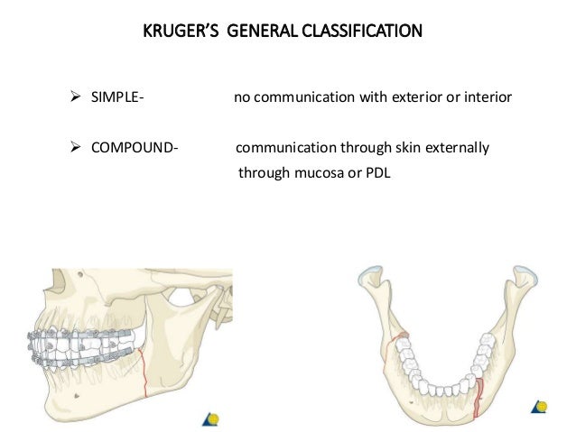 Classification Of Mandible Fracture