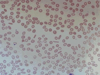 Ida Rbc Shape Classification Of Anaemia & Ida | PPT