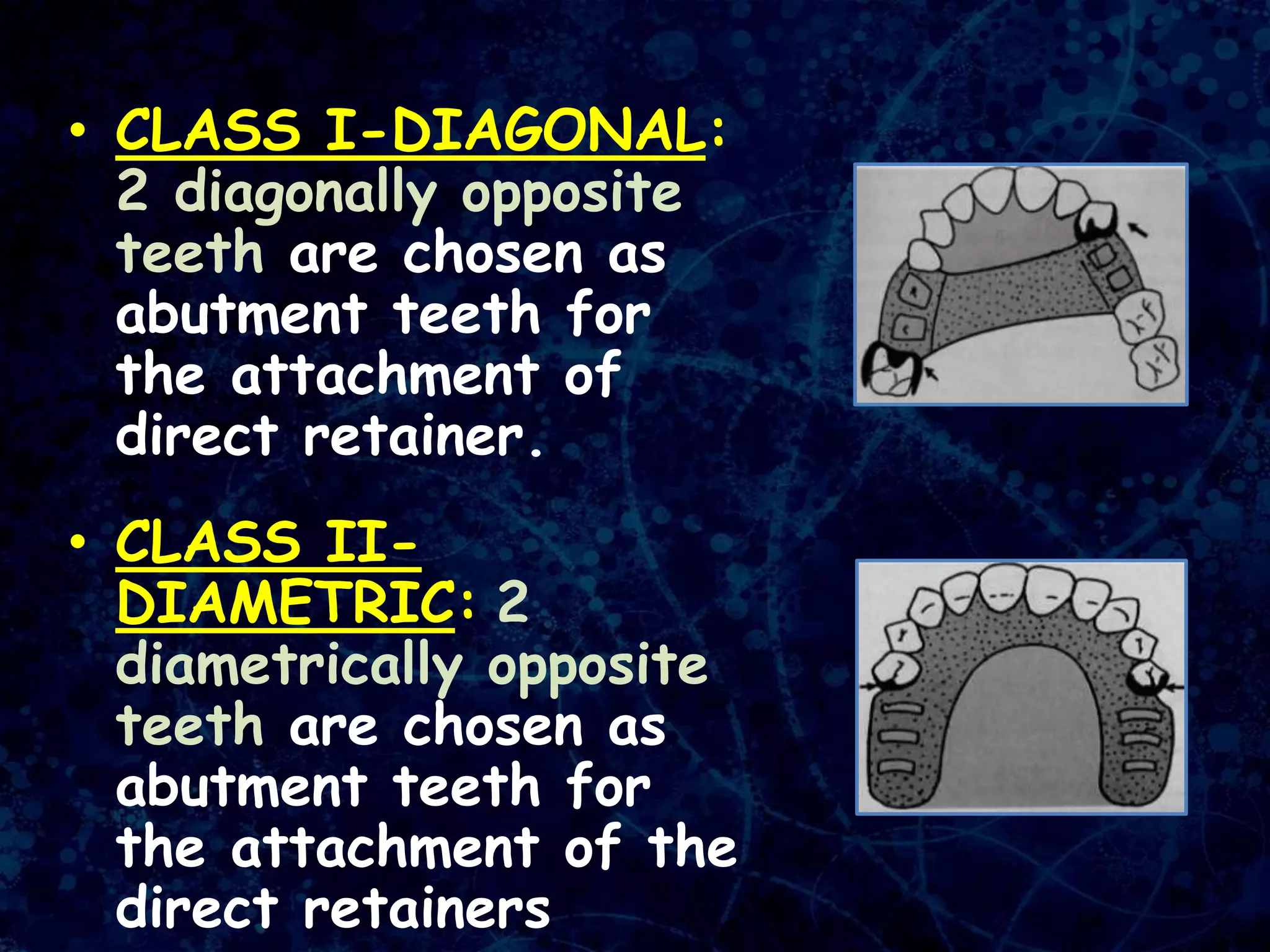 • CLASS I-DIAGONAL:
2 diagonally opposite
teeth are chosen as
abutment teeth for
the attachment of
direct retainer.
• CLASS II-
DIAMETRIC: 2
diametrically opposite
teeth are chosen as
abutment teeth for
the attachment of the
direct retainers
 