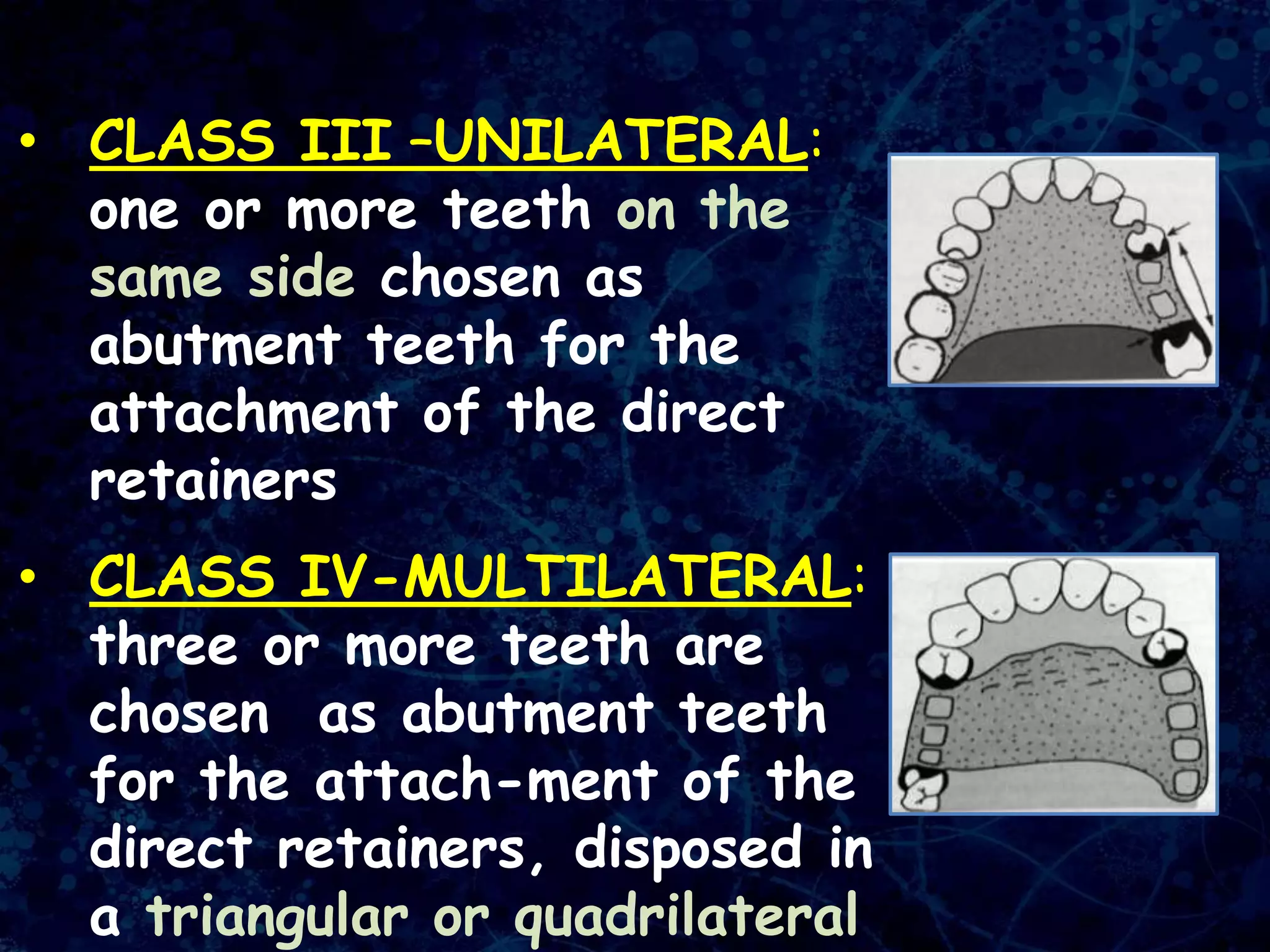 • CLASS III –UNILATERAL:
one or more teeth on the
same side chosen as
abutment teeth for the
attachment of the direct
retainers
• CLASS IV-MULTILATERAL:
three or more teeth are
chosen as abutment teeth
for the attach-ment of the
direct retainers, disposed in
a triangular or quadrilateral
 