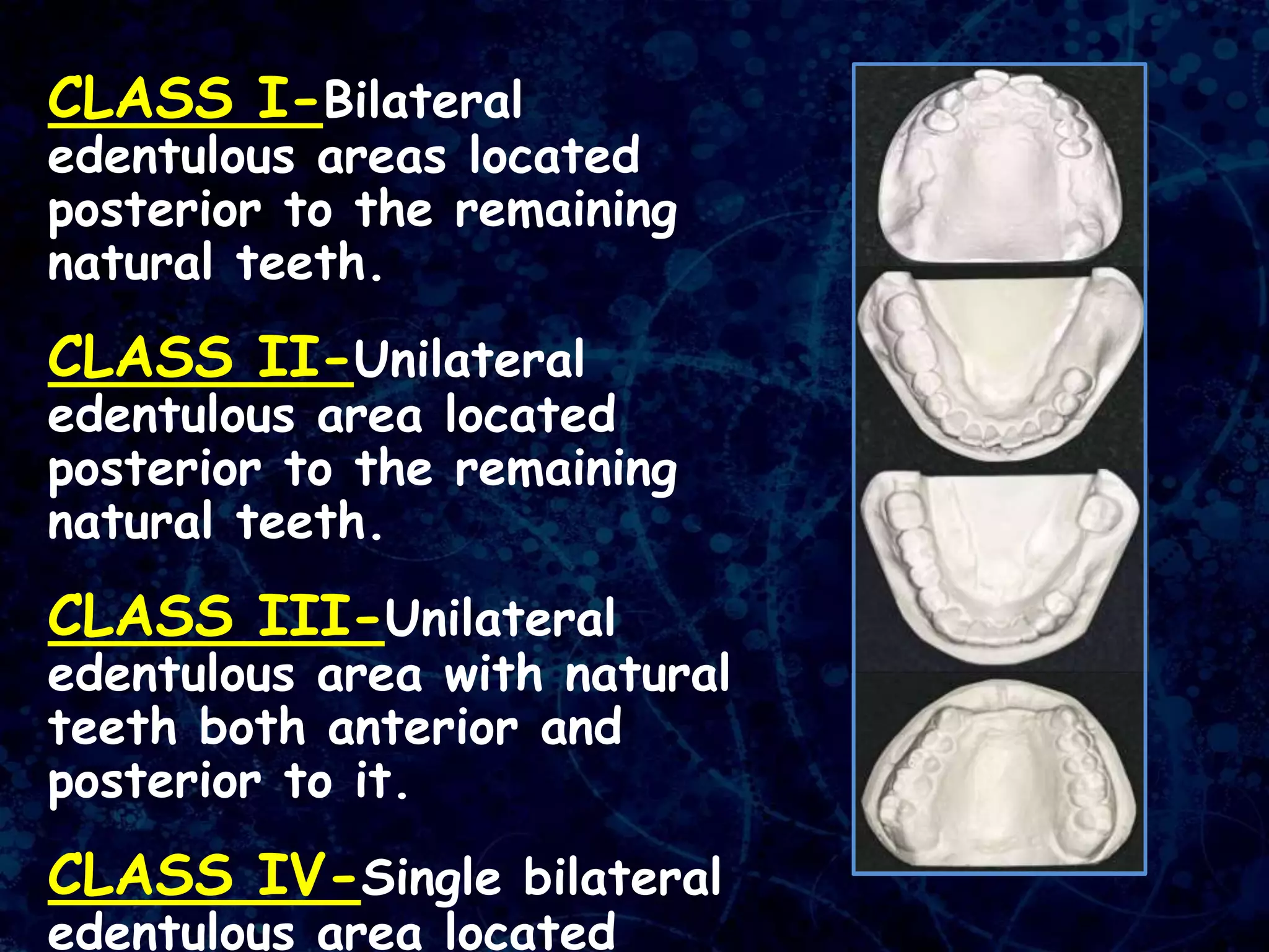 CLASS I-Bilateral
edentulous areas located
posterior to the remaining
natural teeth.
CLASS II-Unilateral
edentulous area located
posterior to the remaining
natural teeth.
CLASS III-Unilateral
edentulous area with natural
teeth both anterior and
posterior to it.
CLASS IV-Single bilateral
edentulous area located
 