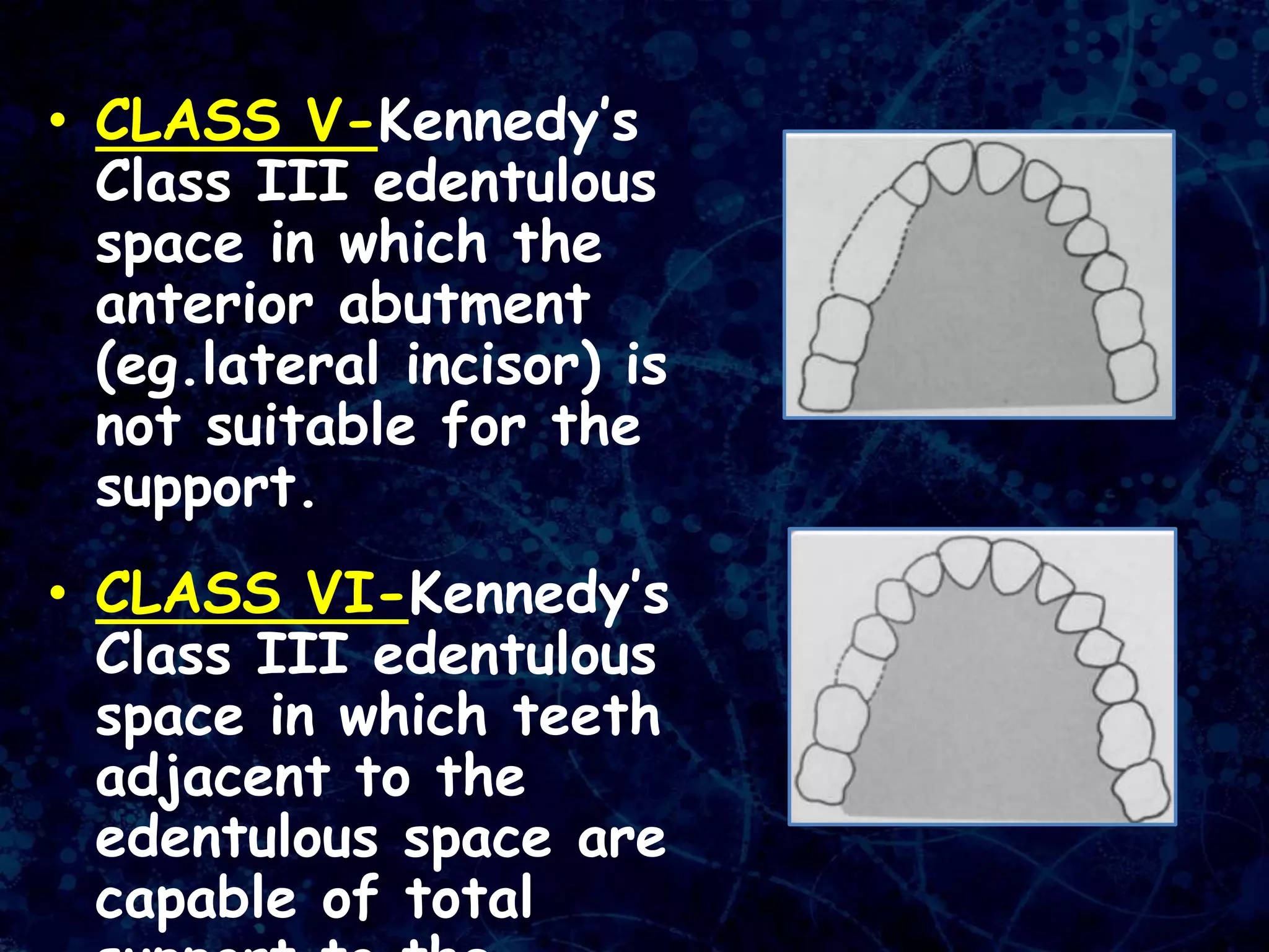 • CLASS V-Kennedy’s
Class III edentulous
space in which the
anterior abutment
(eg.lateral incisor) is
not suitable for the
support.
• CLASS VI-Kennedy’s
Class III edentulous
space in which teeth
adjacent to the
edentulous space are
capable of total
 