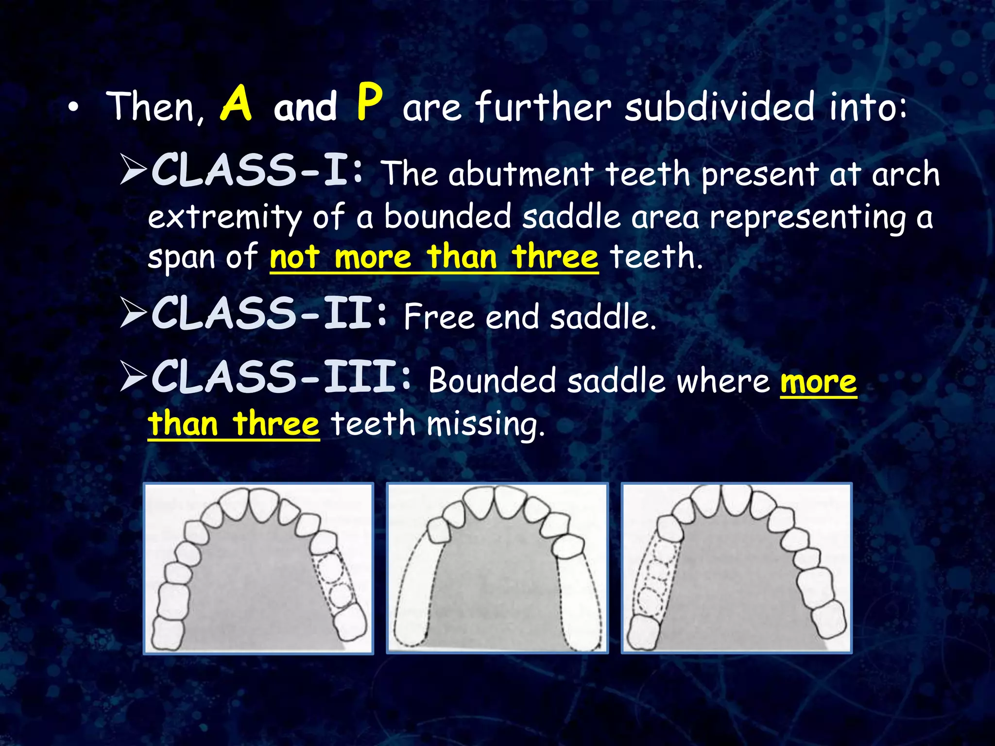• Then, A and P are further subdivided into:
CLASS-I: The abutment teeth present at arch
extremity of a bounded saddle area representing a
span of not more than three teeth.
CLASS-II: Free end saddle.
CLASS-III: Bounded saddle where more
than three teeth missing.
 
